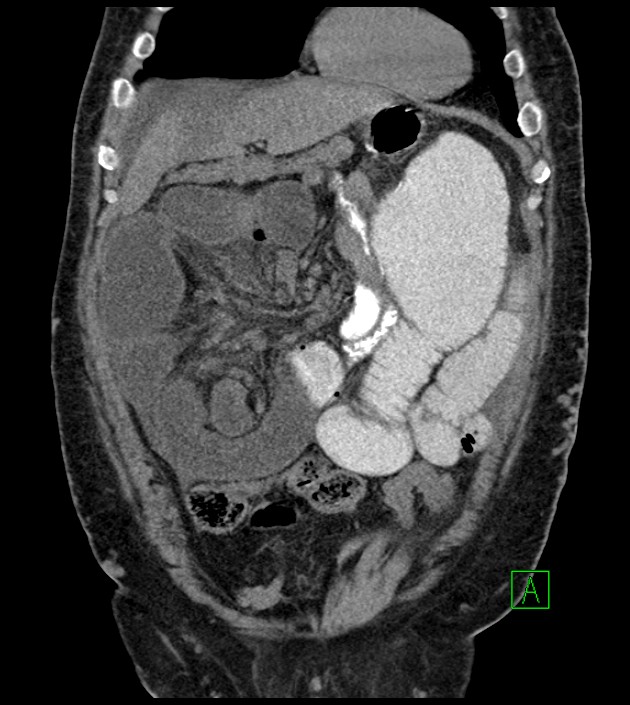Closed-loop small bowel obstruction-internal hernia (Radiopaedia 78439-91096 Coronal non-contrast 33).jpg