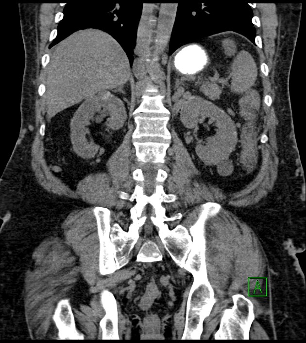 Closed-loop small bowel obstruction-internal hernia (Radiopaedia 78439-91096 Coronal non-contrast 71).jpg