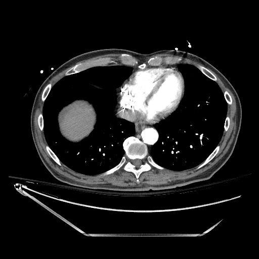 Closed loop obstruction due to adhesive band, resulting in small bowel ischemia and resection (Radiopaedia 83835-99023 B 14).jpg