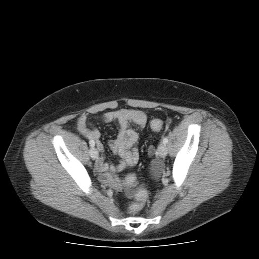 File:Closed loop small bowel obstruction (Radiopaedia 65403-74451 Axial 40).jpg