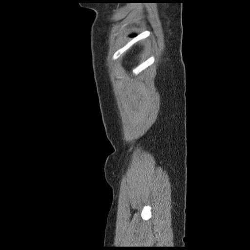 File:Closed loop small bowel obstruction (Radiopaedia 65403-74451 C 106).jpg