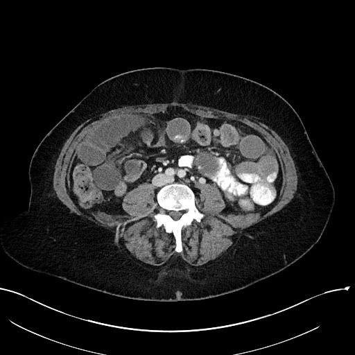 File:Closed loop small bowel obstruction - adhesions (Radiopaedia 59078-66369 Axial 3).jpg