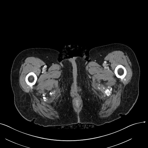 Closed loop small bowel obstruction - adhesions (Radiopaedia 59269-66611 A 151).jpg