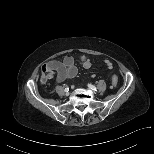 Closed loop small bowel obstruction - adhesions (Radiopaedia 59269-66611 A 91).jpg