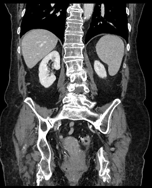 Closed loop small bowel obstruction - adhesions (Radiopaedia 59269-66611 B 86).jpg