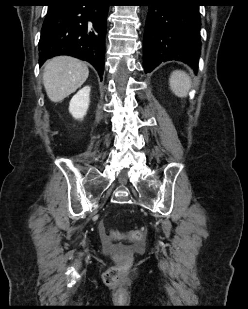 Closed loop small bowel obstruction - adhesions (Radiopaedia 59269-66611 B 95).jpg