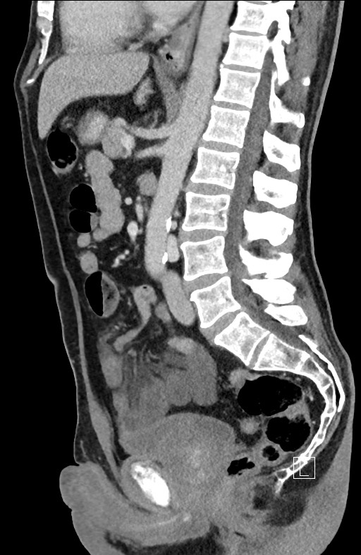 Closed loop small bowel obstruction - internal hernia (Radiopaedia 57806-64778 C 56).jpg