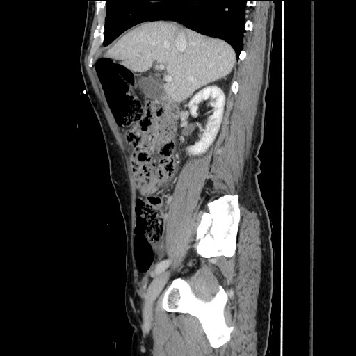 Closed loop small bowel obstruction - omental adhesion causing "internal hernia" (Radiopaedia 85129-100682 C 68).jpg