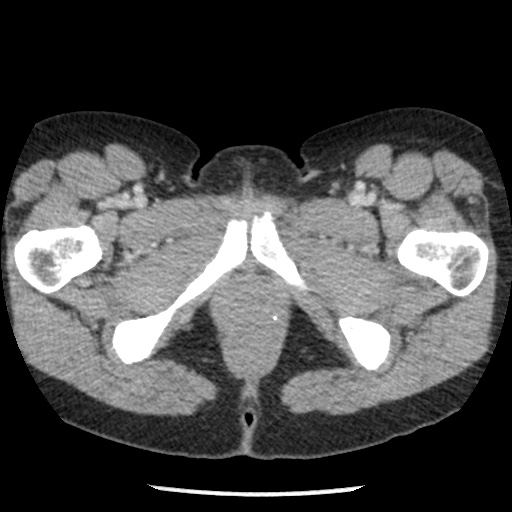 Closed loop small bowel obstruction due to trans-omental herniation (Radiopaedia 35593-37109 A 90).jpg