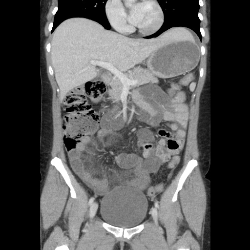 File:Closed loop small bowel obstruction due to trans-omental herniation (Radiopaedia 35593-37109 B 24).jpg
