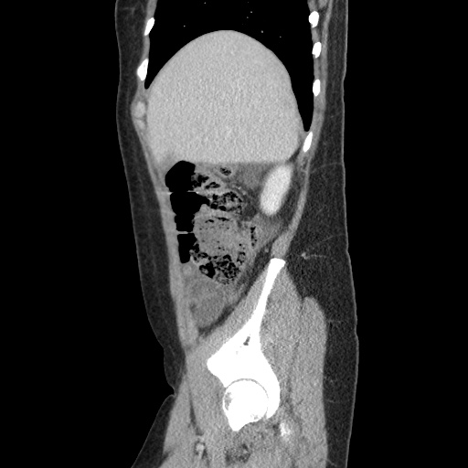 Closed loop small bowel obstruction due to trans-omental herniation (Radiopaedia 35593-37109 C 15).jpg