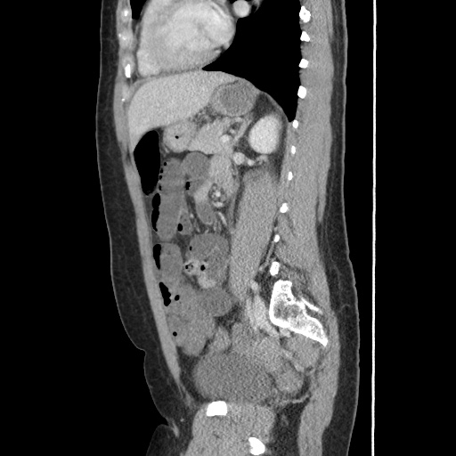 File:Closed loop small bowel obstruction due to trans-omental herniation (Radiopaedia 35593-37109 C 41).jpg