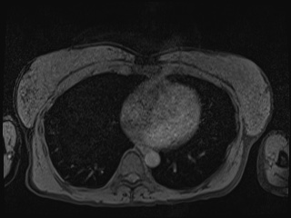 Closed loop small bowel obstruction in pregnancy (MRI) (Radiopaedia 87637-104031 Axial T1 fat sat 3).jpg