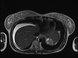 File:Closed loop small bowel obstruction in pregnancy (MRI) (Radiopaedia 87637-104031 Axial T2 8).jpg