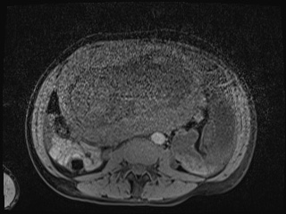 Closed loop small bowel obstruction in pregnancy (MRI) (Radiopaedia 87637-104031 F 5).jpg