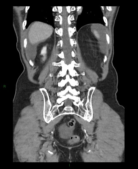 Closed loop small bowel obstruction with ischemia (Radiopaedia 84180-99456 B 12).jpg
