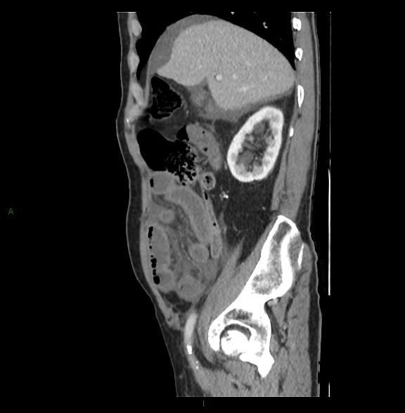 Closed loop small bowel obstruction with ischemia (Radiopaedia 84180-99456 C 28).jpg