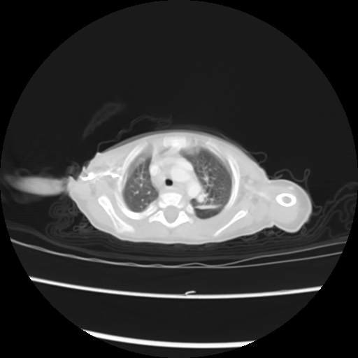 Coarctation of the aorta and patent ductus arteriosus (Radiopaedia 68033-77499 Axial lung window 7).jpg