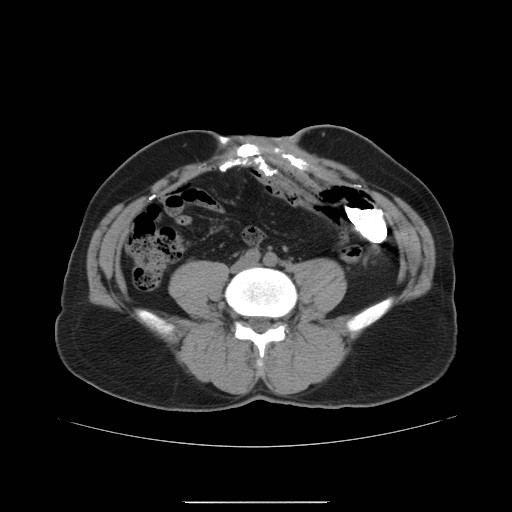 File:Colocutaneous fistula in Crohn's disease (Radiopaedia 29586-30093 D 15).jpg
