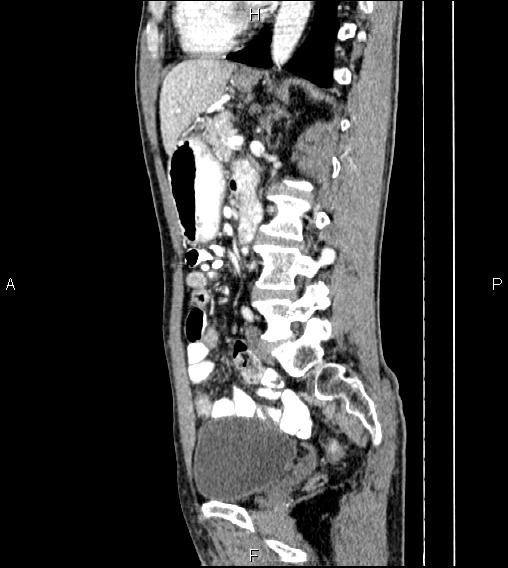 Colon adenocarcinoma - hepatic flexure (Radiopaedia 85635-101395 D 53).jpg