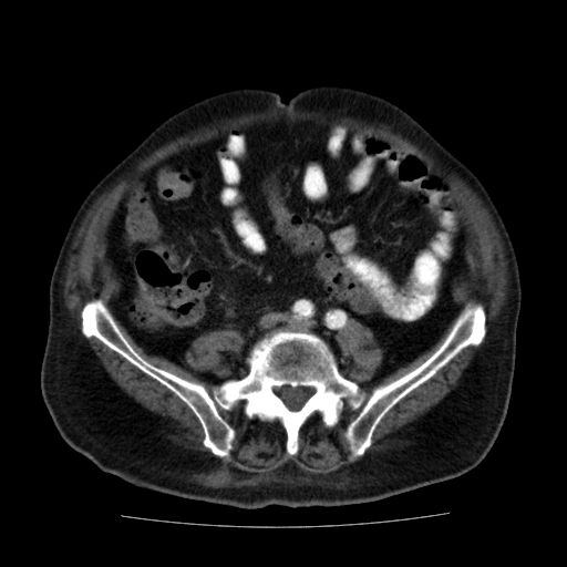 File:Colon cancer with duodenal invasion (Radiopaedia 16278-15958 A 42).jpg