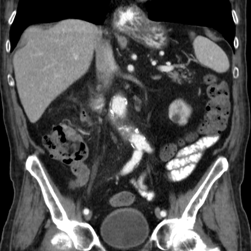File:Colon cancer with duodenal invasion (Radiopaedia 16278-15958 B 32).jpg