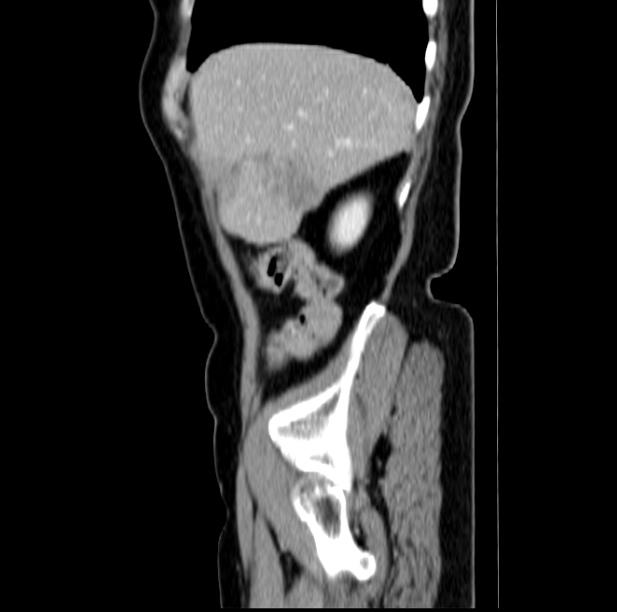Colon carcinoma with hepatic metastases (Radiopaedia 29477-29961 C 10).jpg