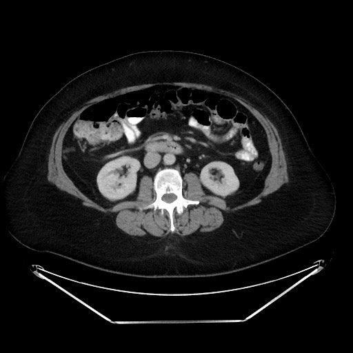 File:Colonic intussusception due to adenocarcinoma (Radiopaedia 86828-102987 A 72).jpg