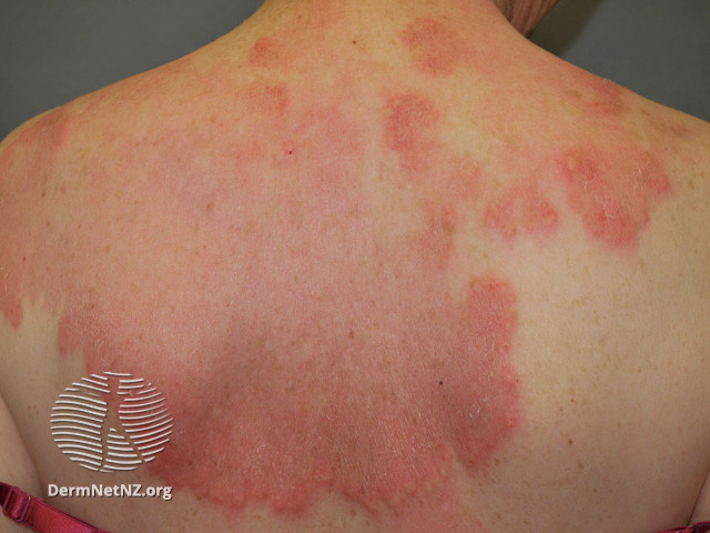 File:Interstitial granulomatous dermatitis (DermNet NZ reactions-granulomatous-dermatitis1).jpg