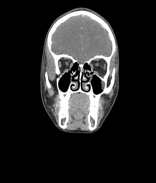 Nasal pyogenic granuloma (lobular capillary hemangioma) (Radiopaedia 85536-101244 D 53).jpg