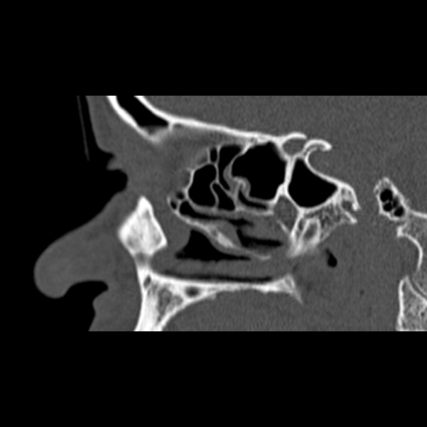 Nasal septal perforation (Radiopaedia 25030-25289 Sagittal bone window 12).jpg