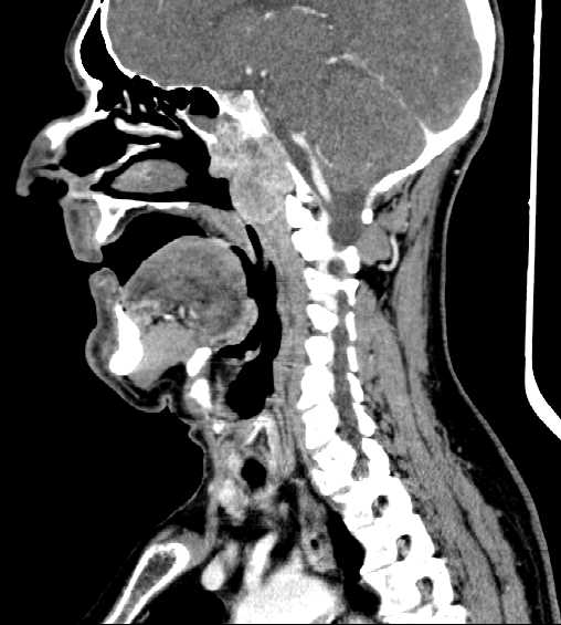 File:Nasopharyngeal carcinoma - infiltrating the clivus (Radiopaedia 62583-70875 C 30).jpg