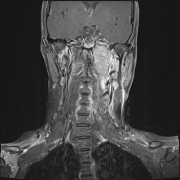 Nasopharyngeal carcinoma with skull base invasion (Radiopaedia 53415-59485 E 16).jpg