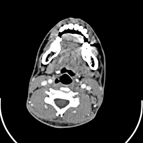 Nasopharyngeal carcinoma with skull base invasion (Radiopaedia 53415-59705 A 120).jpg