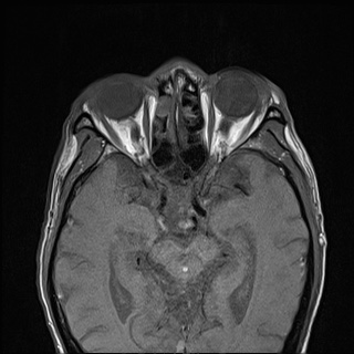 Nasopharyngeal carcinoma with skull base invasion (Radiopaedia 59258-66600 B 6).jpg