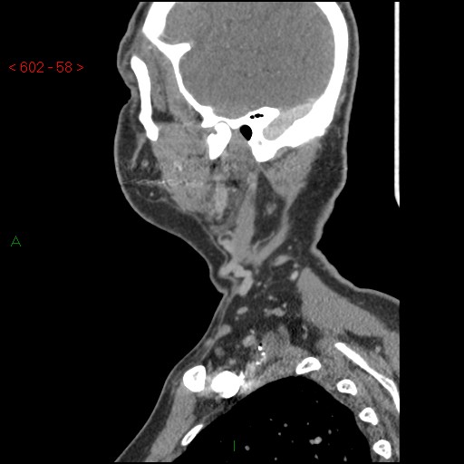 File:Nasopharyngeal lymphoma (Radiopaedia 54235-60433 B 3).jpg