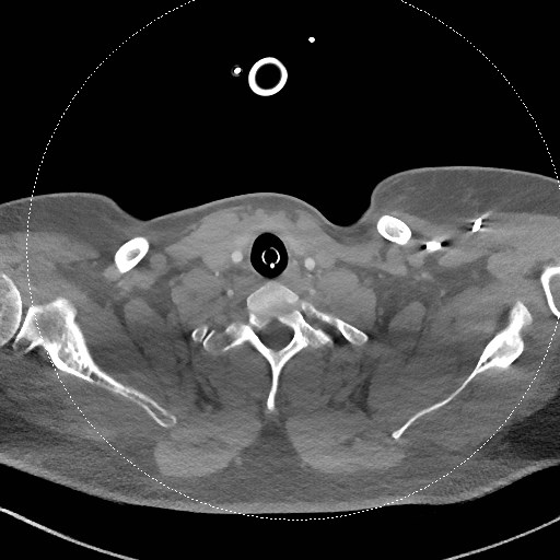 File:Neck CT angiogram (intraosseous vascular access) (Radiopaedia 55481-61945 B 119).jpg