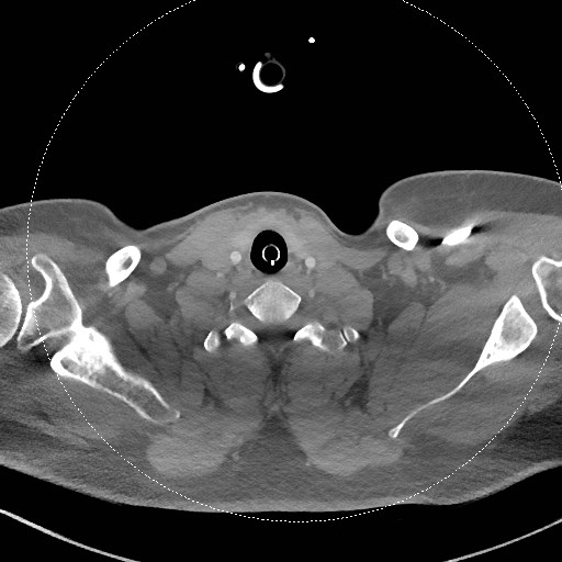 Neck CT angiogram (intraosseous vascular access) (Radiopaedia 55481-61945 B 124).jpg