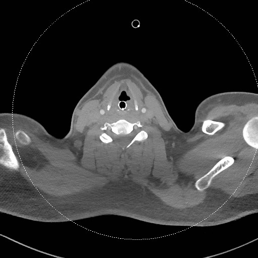 Neck CT angiogram (intraosseous vascular access) (Radiopaedia 55481-61945 B 159).jpg