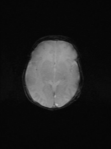 File:Neonatal hypoxic-ischemic encephalopathy (Radiopaedia 41406-44277 Axial Gradient Echo 11).jpg