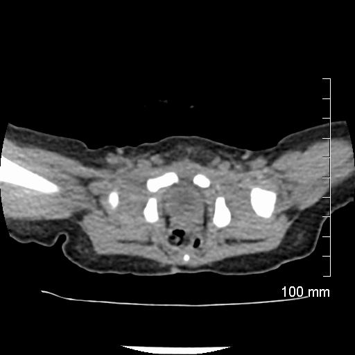 File:Neonatal neuroblastoma (Radiopaedia 56651-63438 Axial non-contrast 78).jpg