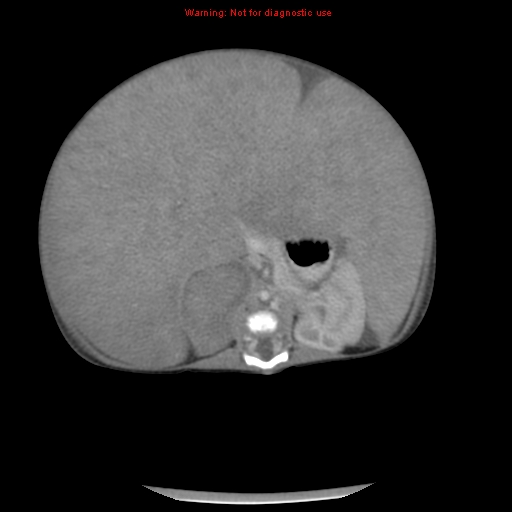 File:Neonatal neuroblastoma (Radiopaedia 9564-10223 A 26).jpg