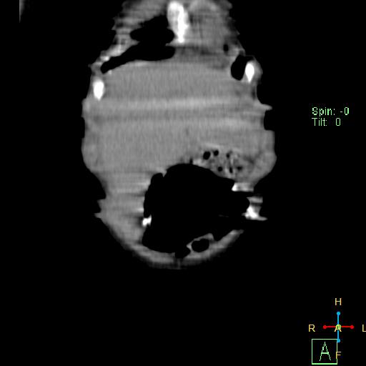 File:Neuroblastoma (Radiopaedia 24751-25016 B 2).jpg