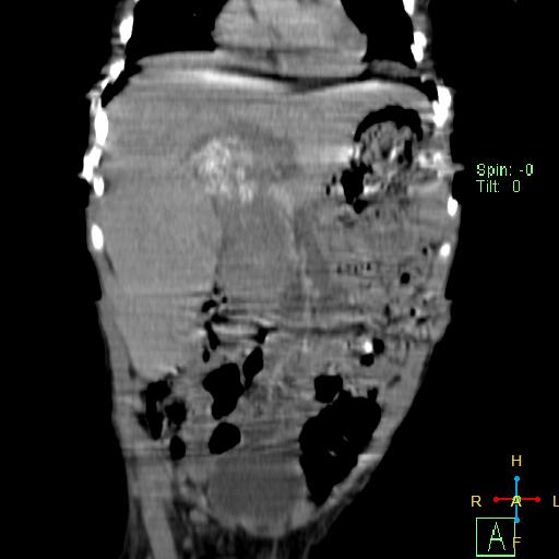 File:Neuroblastoma (Radiopaedia 24751-25016 B 9).jpg