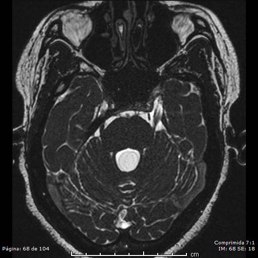 Neurocysticercosis (Radiopaedia 58636-65832 I 68).jpg