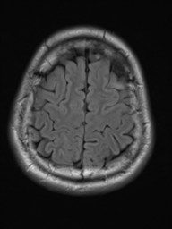 File:Neurofibromatosis type 2 (Radiopaedia 44936-48838 Axial FLAIR 20).png