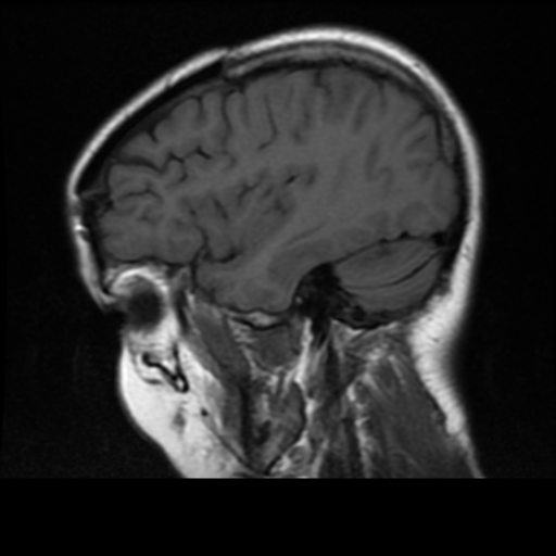 File:Neurofibromatosis type 2 (Radiopaedia 45229-49244 Sagittal T1 16).png