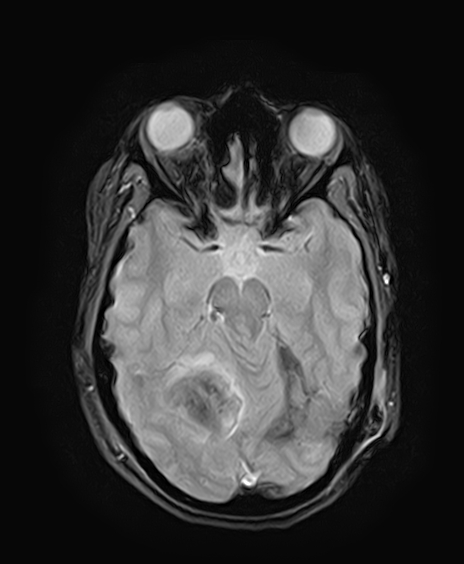 File:Neurofibromatosis type 2 (Radiopaedia 66211-75401 Axial Gradient Echo 13).jpg