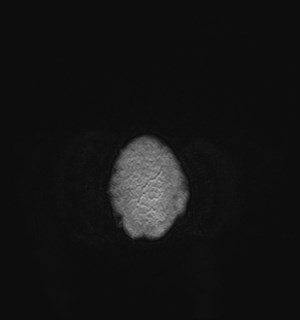 Neurofibromatosis type 2 (Radiopaedia 79097-92049 Axial T1 C+ 192).jpg