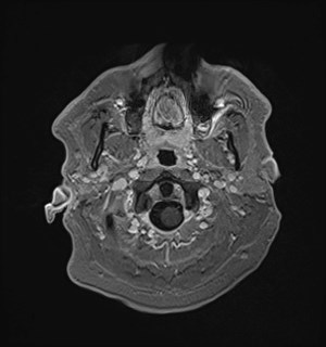 Neurofibromatosis type 2 (Radiopaedia 79097-92049 Axial T1 C+ 24).jpg